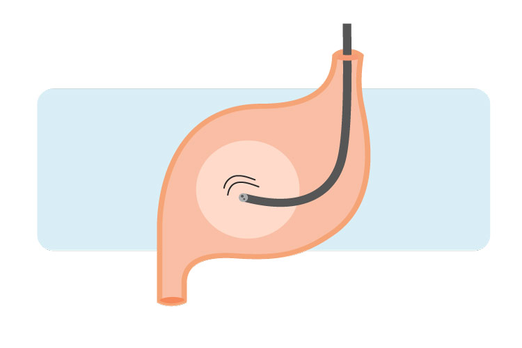 上部内視鏡（胃カメラ）のイメージ